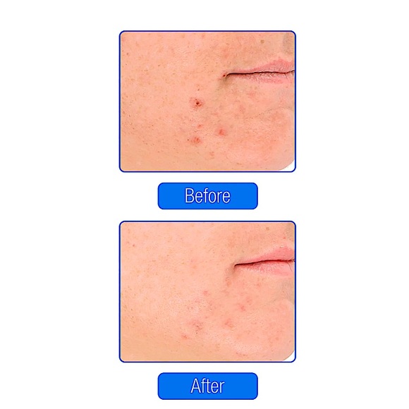 LightStim for Acne - Picture 5 of 5